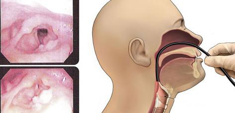 příznaky rakoviny hrtanu laryngeální