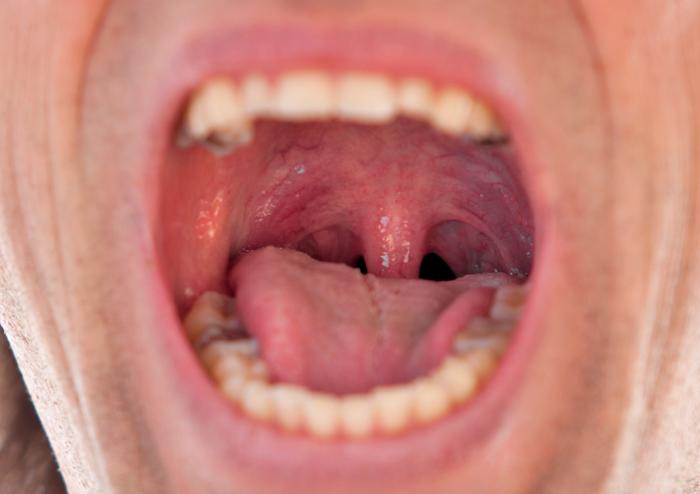 I sintomi della malattia della gola