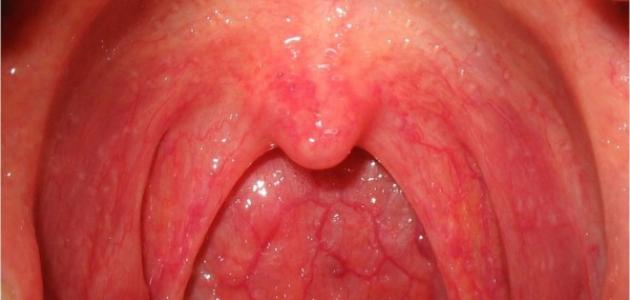 Mal di gola faringite