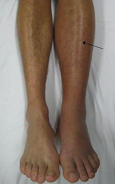 tromboflebite delle gambe