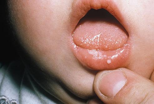 mughetto nei bambini nella lingua