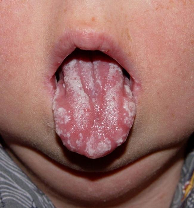 mughetto nella bocca dei bambini