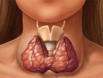 sintomi della tiroide