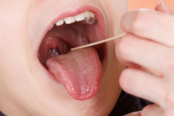 tonsillite nei bambini sintomi e foto trattamento