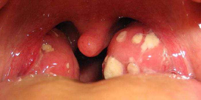 sintomi di tonsillite acuta e trattamento nei bambini