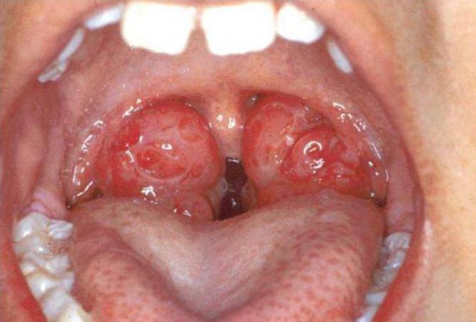 sintomi e trattamento della tonsillite cronica nei bambini