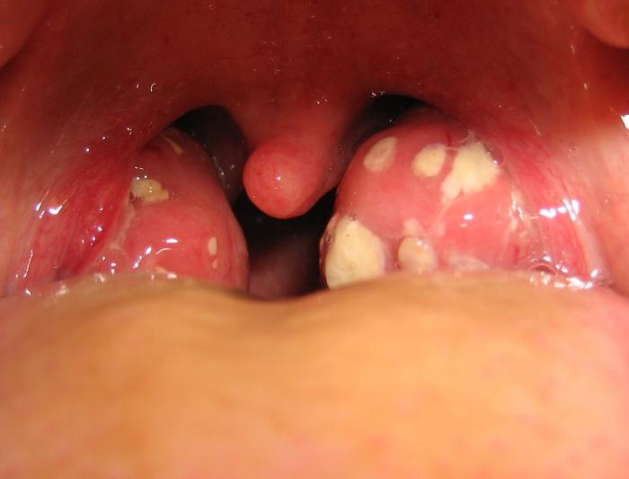 sintomi di tonsillite