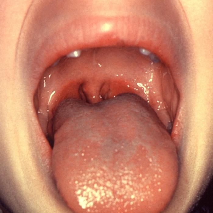 segni di tonsillite cronica