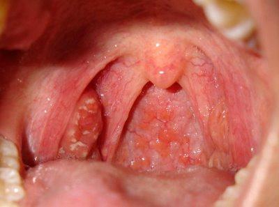 sintomi di tonsillite acuta
