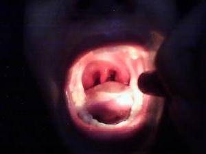trattamento della tonsillite