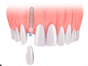 přední implantace zubů
