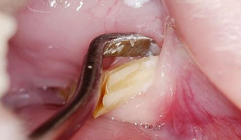 extrakce zubů cystou