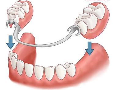 Protezy dentystyczne