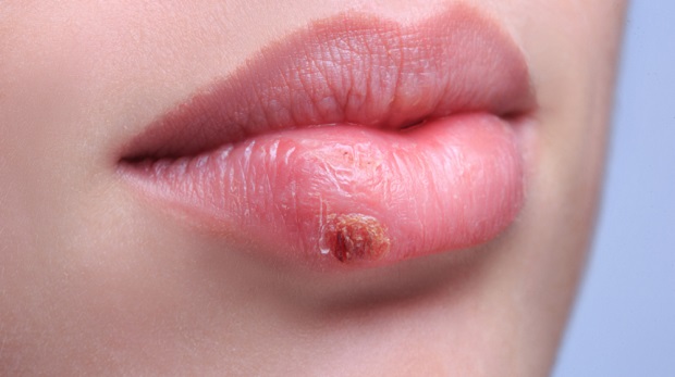 Herpes sulle labbra