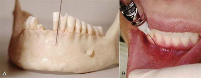 торална анестезия в стоматологията