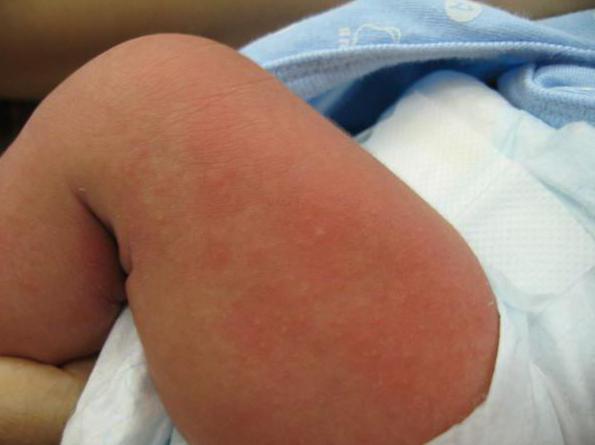 toksični eritem novorojenčka povzroči zdravljenje