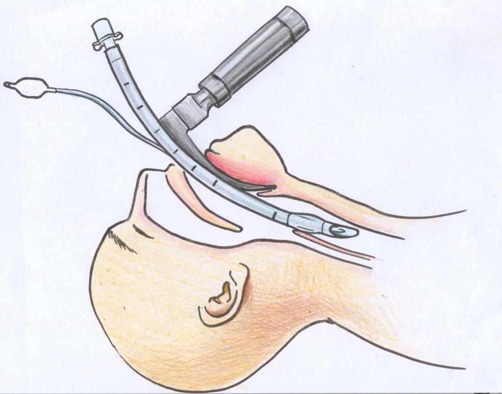 intubazione tracheale