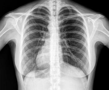 рентгенова снимка на белите дробове