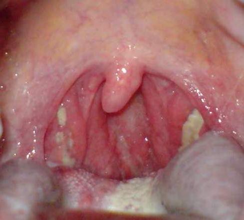 tonsillite purulenta nei bambini