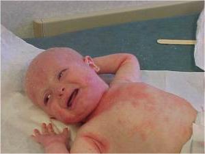 dermatite atopica nel trattamento dei neonati