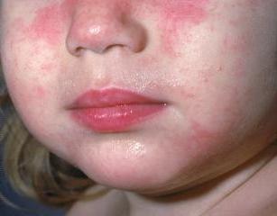 alergická dermatitida na obličeji