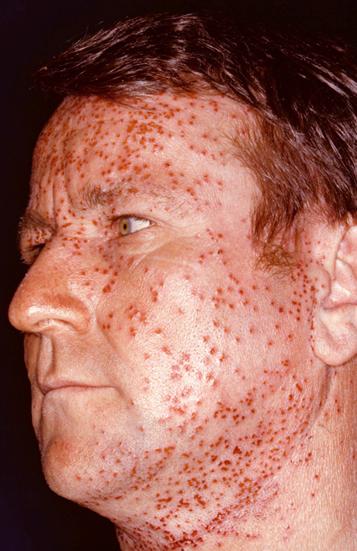 come trattare la dermatite allergica
