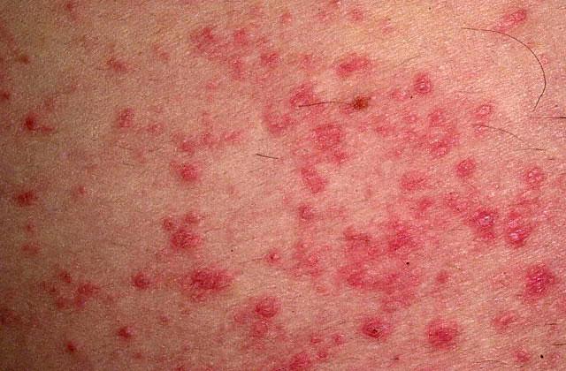 alergijskega dermatitisa