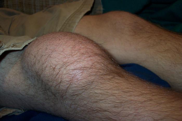 trattamento dei sintomi della borsite del ginocchio