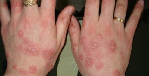 trattamento mani eczema