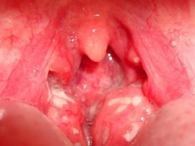 Zdravljenje folikularne bolečine v grlu