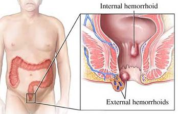 léčba hemoroidů třetí fáze bez operace