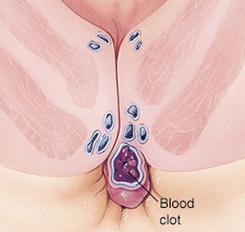 léčba hemoroidy bez přezkoumání chirurgie