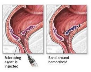 лечение на хемороиди етап 4 без операция