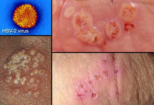 herpes sul trattamento fotografico del corpo