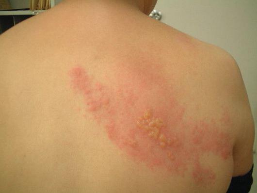 herpes sulla pelle del trattamento del corpo