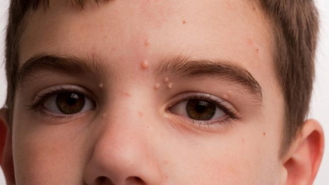zdravljenje moluscum contagiosum pri otrocih