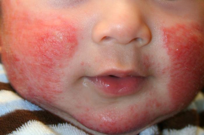 perorální dermatitida při léčbě dětí