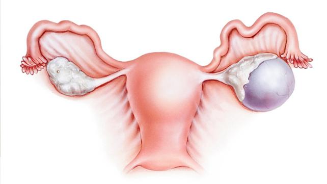 léčba ovariálních cyst bez chirurgického zákroku