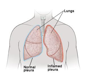 лечение на плеврит на белите дробове