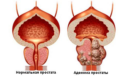 Léčba adenomu prostaty bez operace