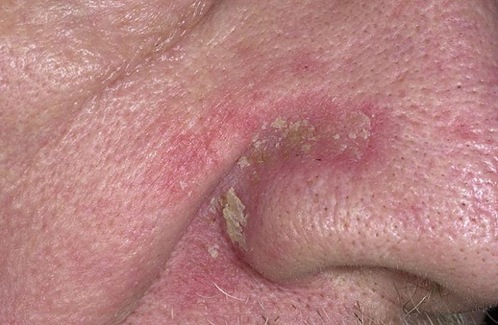 лечение на себореен дерматит на лицето