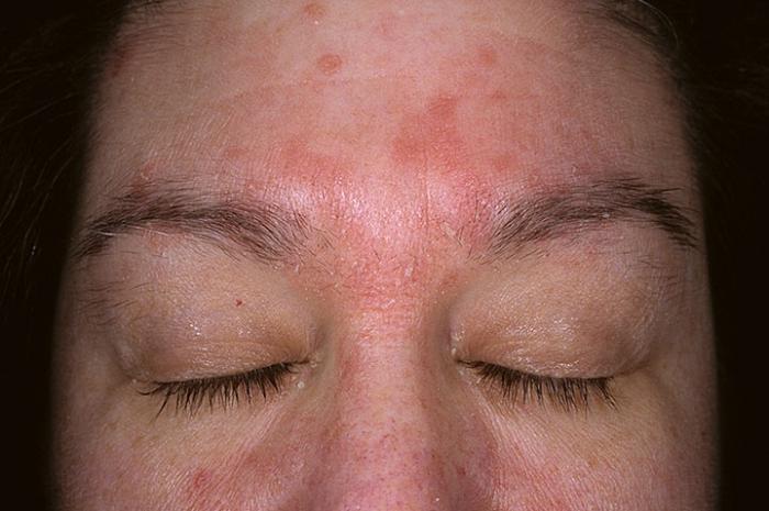 liječenje seboreičnog dermatitisa na licu
