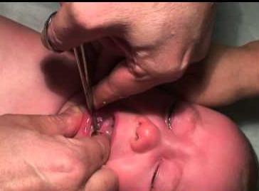 tagliando il frenulo della lingua nei neonati