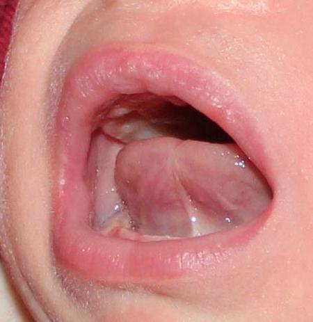 tagliare le briglie della lingua nei bambini