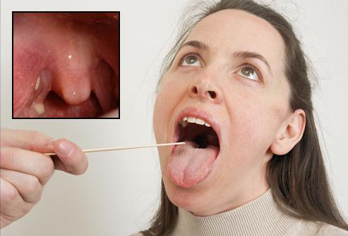 spine di tonsilla bianche