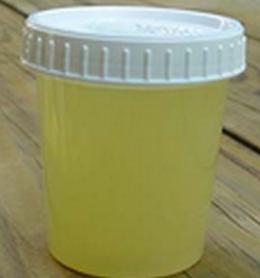 urina torbida nella causa di un bambino