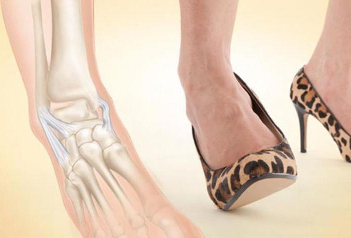 skręcona kostka obrzęk stopy, co zrobić leczenie