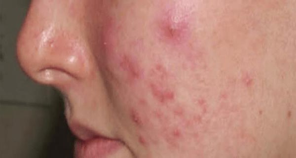 typy akné na obličeji