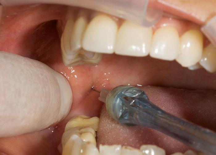 општа анестезија у стоматологији