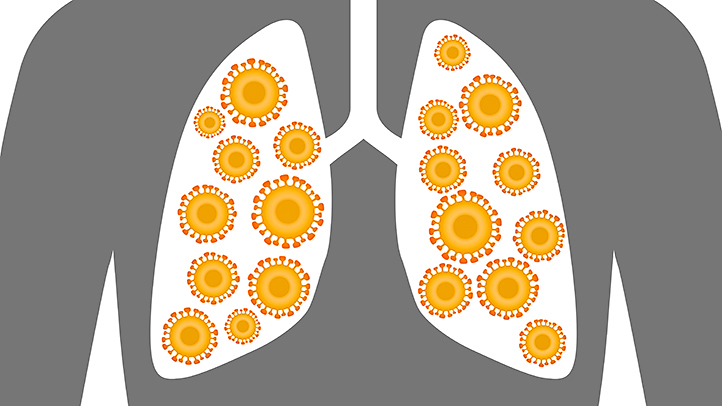 caratteristiche della polmonite lobare